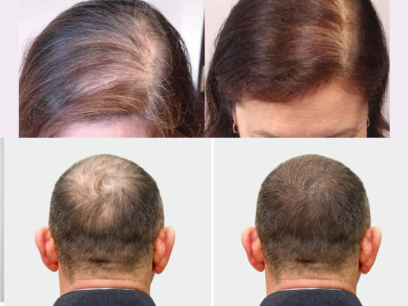 Hair Fall Control