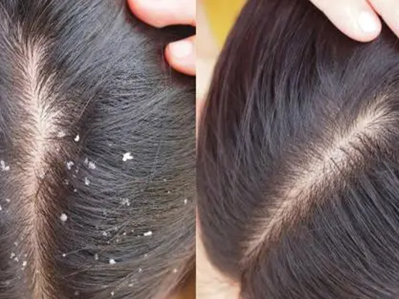 Anti Dandruff