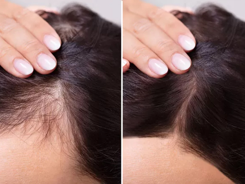 Androgenic Aloepaecia & Aerretta