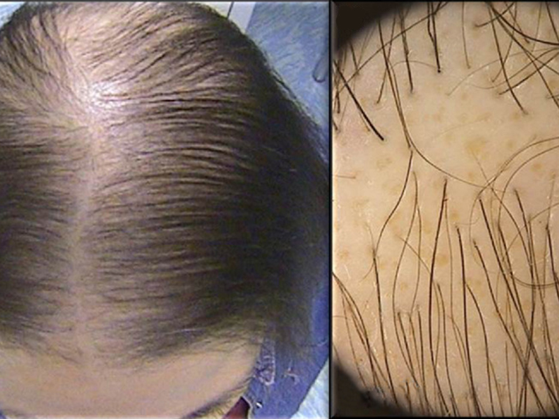 Psoriasis Treatment